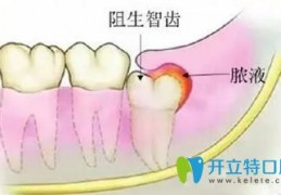 [蛀牙导致牙龈炎能自愈吗]不要再纠结智齿冠周炎能自愈吗？教你三个方法轻松治疗疼痛