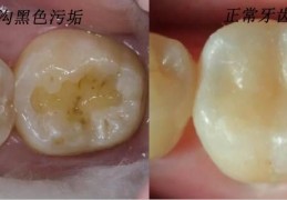 [虫牙直接封起来会掉吗]牙齿上的黑色污垢是蛀牙吗？那蛀牙如何让它停止腐蚀呢？