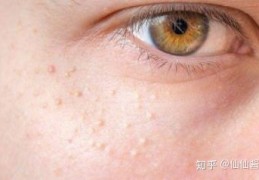 [突然长许多脂肪粒]脸上长脂肪粒，除掉它其实很简单