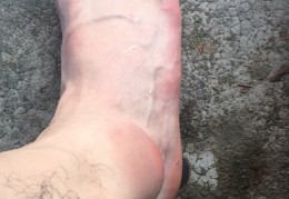 脚踝韧带断裂经历分享