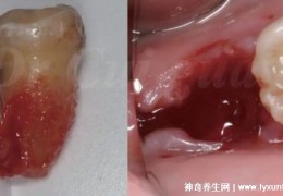 [拔牙第二天出很多血怎么办]拔牙后七天窟窿恢复图真实，一个星期长新牙骨(一个月完全恢复)