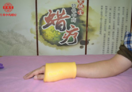 蜡疗、中药蜡疗调理腕关节扭挫伤的方法