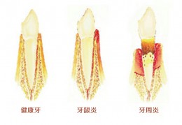 [恒牙为什么有点松了]大牙活动了怎么办？大牙松动的原因